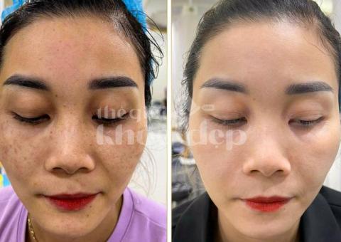 Trị Nám Tàn Nhang – Giải Pháp Kết Hợp Peel Da & Laser Chuẩn Y Khoa - 2/4