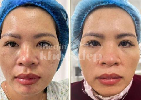 Trị Nám Tàn Nhang – Giải Pháp Kết Hợp Peel Da & Laser Chuẩn Y Khoa - 3/4
