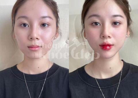 Tiêm Filler Tạo Hình Môi – Giải Pháp Sở Hữu Bờ Môi Căng Mọng, Quyến Rũ