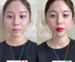 Tiêm Filler Tạo Hình Môi – Giải Pháp Sở Hữu Bờ Môi Căng Mọng, Quyến Rũ