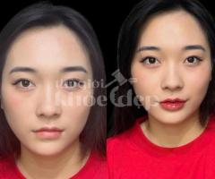 Tiêm Filler Nâng Mũi – Giải Pháp An Toàn, Không Phẫu Thuật, Hiệu Quả Tức Thì