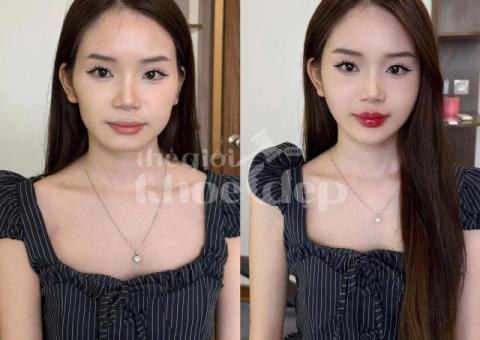 Cấy HA Collagen Tạo Hình Môi – Giải Pháp Cho Môi Căng Mọng Tự Nhiên