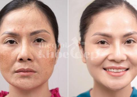 Trị nám hỗn hợp hiệu quả – Công nghệ chuẩn y khoa, cam kết an toàn - 1/4