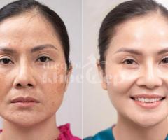 Trị nám hỗn hợp hiệu quả – Công nghệ chuẩn y khoa, cam kết an toàn