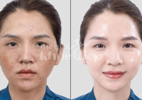 Trị nám chân sâu hiệu quả, an toàn – Giải pháp da sáng mịn bền lâu - 1/4