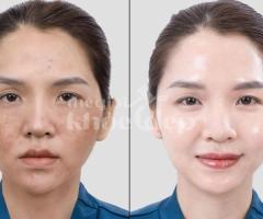 Trị nám chân sâu hiệu quả, an toàn – Giải pháp da sáng mịn bền lâu