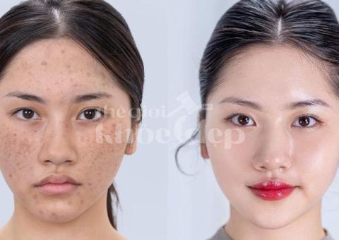 Trị nám chân sâu hiệu quả, an toàn – Giải pháp da sáng mịn bền lâu - 2/4