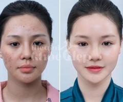 Trị nám hỗn hợp tận gốc – Công nghệ mới, an toàn, hiệu quả bền lâu