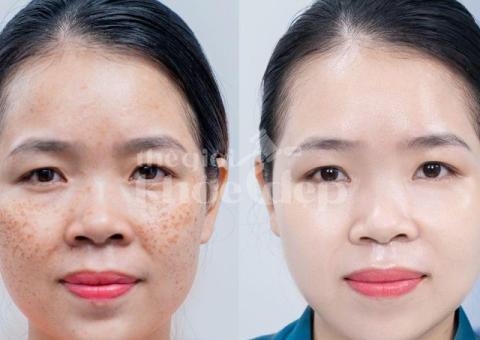 Trị nám hỗn hợp tận gốc – Công nghệ mới, an toàn, hiệu quả bền lâu - 4/6