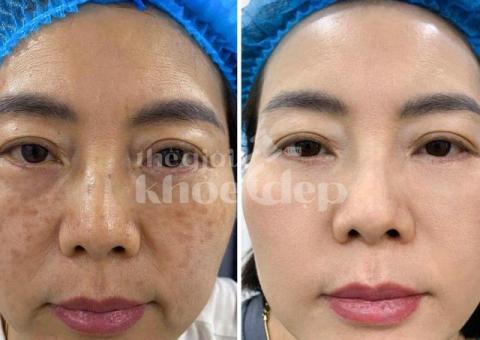 Điều trị nám da an toàn – Hiệu quả tận gốc, trẻ hóa làn da - 1/5