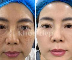 Điều trị nám da an toàn – Hiệu quả tận gốc, trẻ hóa làn da