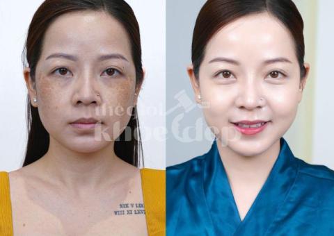 Dịch vụ trị nám da công nghệ cao – An toàn, hiệu quả, không tái phát - 1/4