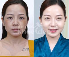 Dịch vụ trị nám da công nghệ cao – An toàn, hiệu quả, không tái phát