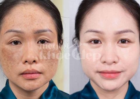 Dịch vụ trị nám da công nghệ cao – An toàn, hiệu quả, không tái phát - 2/4