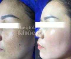 Trị nám mảng lâu năm – Giải pháp công nghệ cao an toàn, hiệu quả bền vững