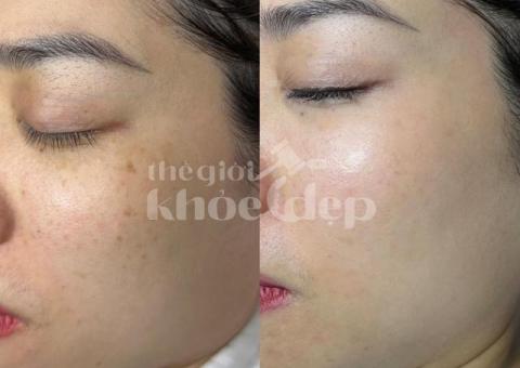 Trị nám mảng lâu năm – Giải pháp công nghệ cao an toàn, hiệu quả bền vững - 2/5