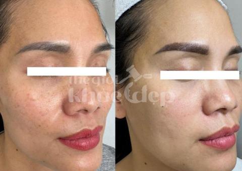 Trị nám mảng lâu năm – Giải pháp công nghệ cao an toàn, hiệu quả bền vững - 3/5