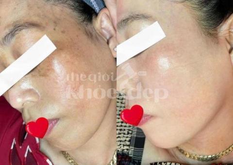 Trị nám mảng lâu năm – Giải pháp công nghệ cao an toàn, hiệu quả bền vững - 5/5