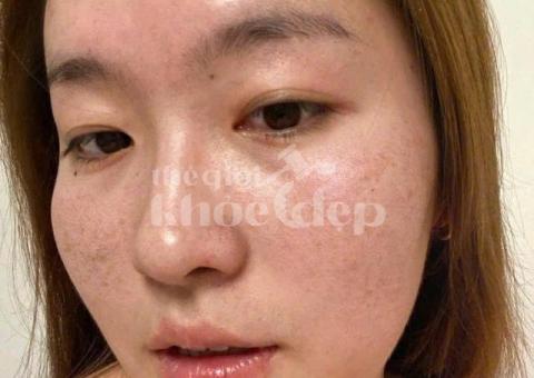 Trị nám hỗn hợp và tàn nhang – Giải pháp công nghệ cao, hiệu quả toàn diện - 1/3