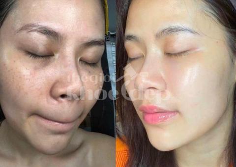 Trị nám do nội tiết tố và stress – Giải pháp công nghệ cao, hiệu quả bền vững - 5/5