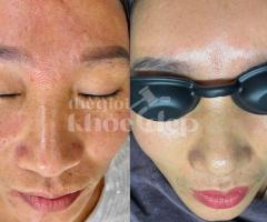 Trị nám do ánh nắng và lão hóa – Giải pháp công nghệ cao, an toàn và hiệu quả