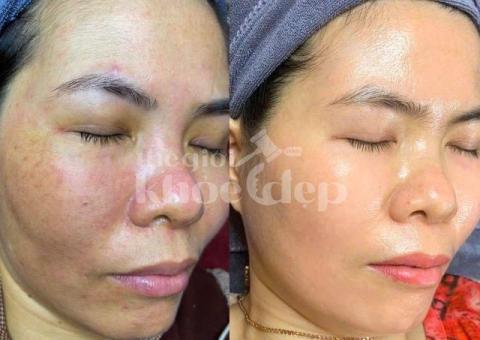 Trị nám do ánh nắng và lão hóa – Giải pháp công nghệ cao, an toàn và hiệu quả - 2/3