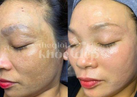 Trị nám do ánh nắng và lão hóa – Giải pháp công nghệ cao, an toàn và hiệu quả - 3/3