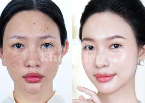 Trị nám sau peel/lột da thất bại – Giải pháp an toàn, phục hồi da sáng khỏe - 1/4