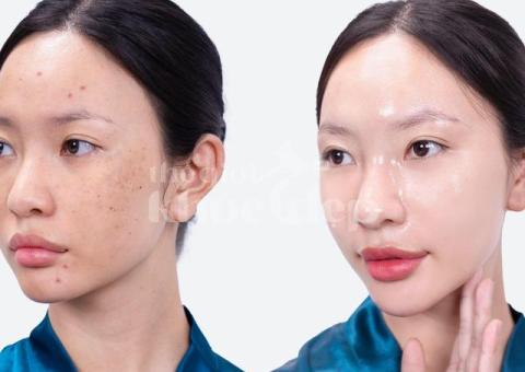 Trị nám sau peel/lột da thất bại – Giải pháp an toàn, phục hồi da sáng khỏe - 3/4