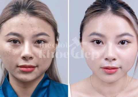 Trị nám sau peel/lột da thất bại – Giải pháp an toàn, phục hồi da sáng khỏe - 4/4
