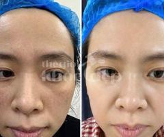 Trị nám sau sinh – Giải pháp an toàn, phục hồi da sáng mịn