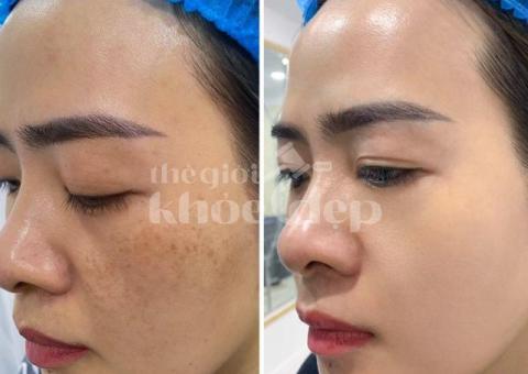 Trị nám sau sinh – Giải pháp an toàn, phục hồi da sáng mịn - 2/4