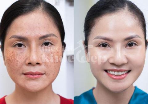 Trị nám da mặt nhẹ – Giải pháp nhanh chóng, an toàn, hiệu quả - 1/3