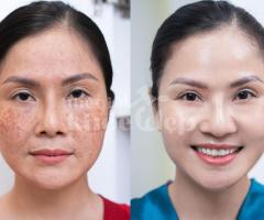 Trị nám da mặt nhẹ – Giải pháp nhanh chóng, an toàn, hiệu quả