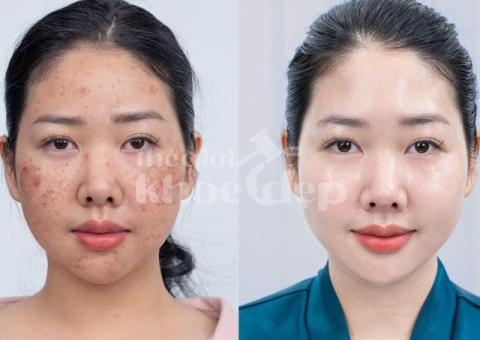 Trị nám da mặt nhẹ – Giải pháp nhanh chóng, an toàn, hiệu quả - 3/3