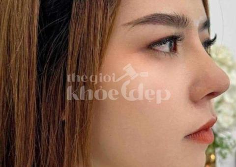 Nâng mũi bán cấu trúc 2025 – Dáng mũi đẹp tự nhiên, an toàn chuẩn y khoa - 1/3