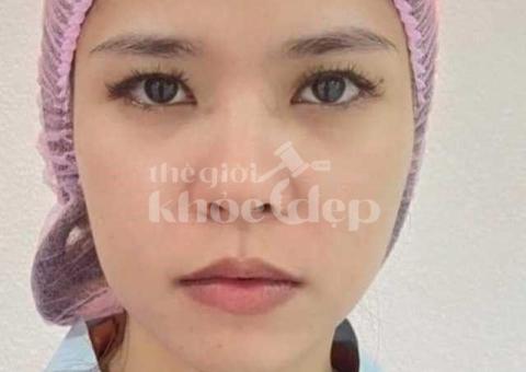 Nâng mũi bán cấu trúc 2025 – Dáng mũi đẹp tự nhiên, an toàn chuẩn y khoa - 2/3