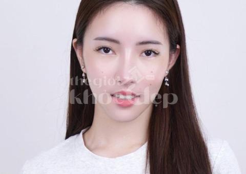 Nâng mũi cấu trúc toàn phần 2025 – Dáng mũi cao thanh tú, chuẩn y khoa - 3/3