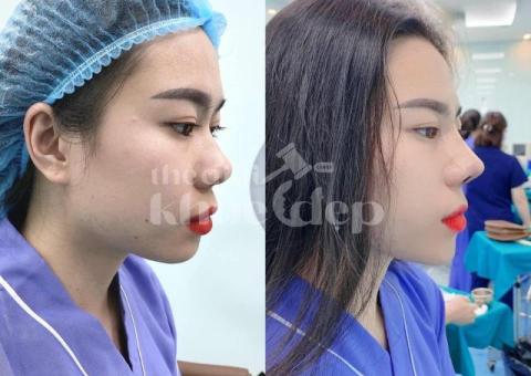 Nâng mũi S Line Hàn Quốc 2025 – Dáng mũi mềm mại, thanh tú