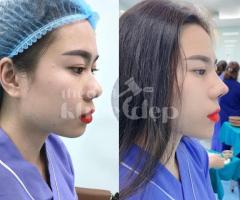 Nâng mũi S Line Hàn Quốc 2025 – Dáng mũi mềm mại, thanh tú