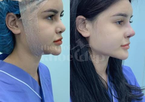 Nâng mũi Bọc Sụn 2025 – Đầu mũi mềm mại, sống mũi tự nhiên