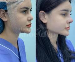 Nâng mũi Bọc Sụn 2025 – Đầu mũi mềm mại, sống mũi tự nhiên
