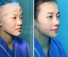Nâng mũi Sline kết hợp thu gọn cánh mũi 2025 – Dáng mũi hoàn hảo, hài hòa