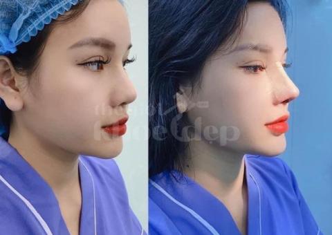 Nâng mũi Hàn Quốc cấu trúc 4D – Dáng mũi chuẩn đẹp, an toàn 2025