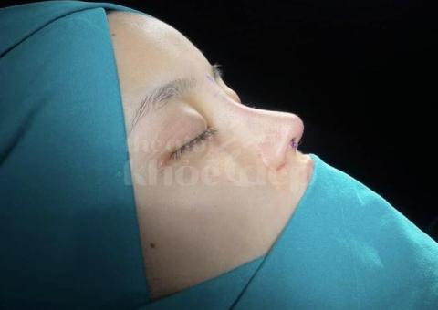 Nâng mũi đẹp chuẩn y khoa – An toàn, tự nhiên, bền vững - 1/7