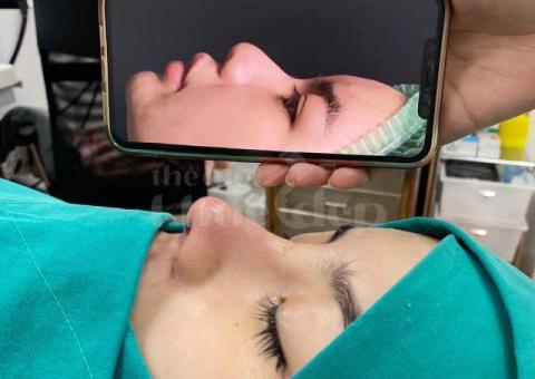 Nâng mũi đẹp chuẩn y khoa – An toàn, tự nhiên, bền vững - 6/7