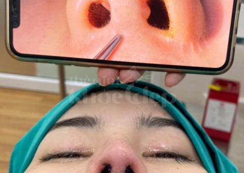 Nâng mũi đẹp chuẩn y khoa – An toàn, tự nhiên, bền vững - 7/7