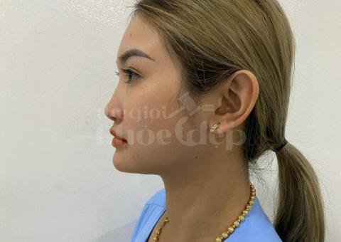 Dịch Vụ Nâng Mũi Đẹp An Toàn – Bác Sĩ Chuyên Khoa Tư Vấn, Cam Kết Hiệu Quả - 4/6