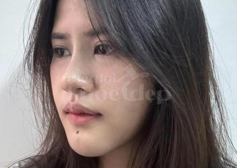 Dịch vụ nâng mũi cấu trúc 4D – An toàn, đẹp tự nhiên, duy trì lâu dài - 4/4