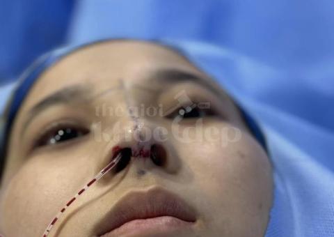 Nâng mũi đẹp tự nhiên, an toàn – Giải pháp hoàn hảo từ bác sĩ uy tín - 2/4